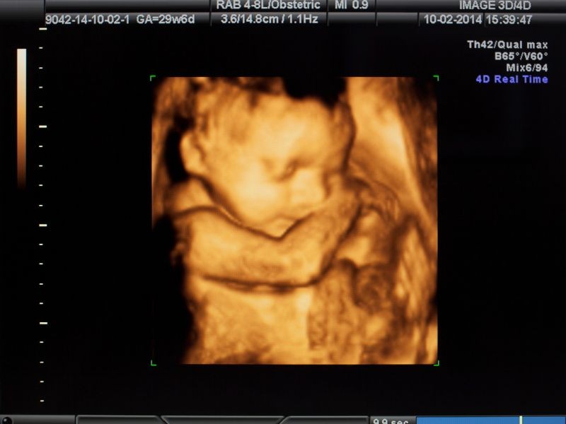 Ultrassom Morfológico